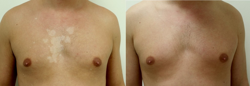 Vitiligo resultaat lichttherapie Resultaat behandeling vitiligo lichttherapie