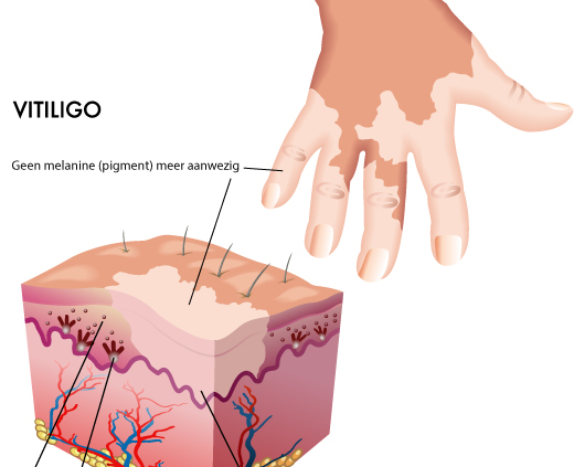Vitiligo illustratie