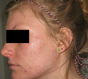 acne weg na pdt behandeling