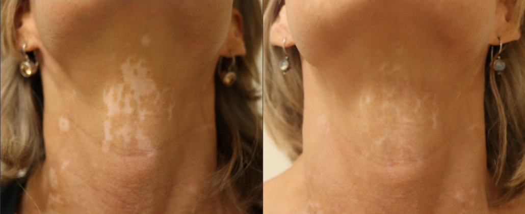 Resultaat van een blaardak transplantatie bij vitiligo